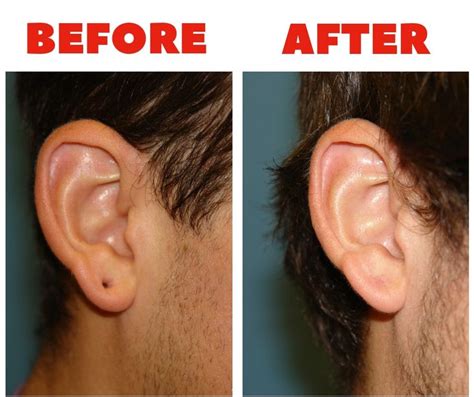 Earlobe Repair Is One Of The Most Common Office Procedures Used To