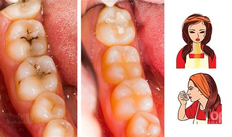 You can read more about sealants for children in. Home Remedies for Tooth Decay and Cavities | Top 10 Home ...