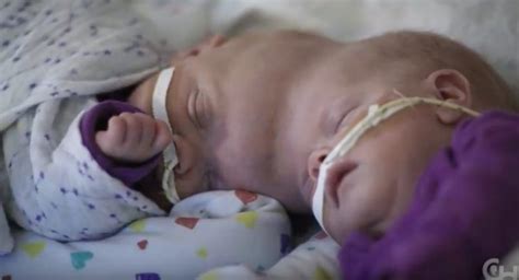 Conjoined Twins Abby And Erin Delaney Now Two Have Beaten All The Odds