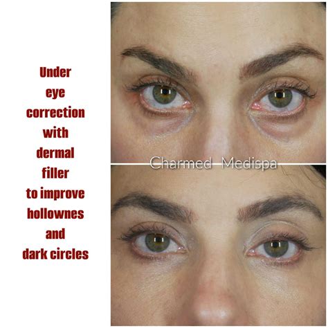 Under Eye Correction With Dermal Filler Charmed Medispa