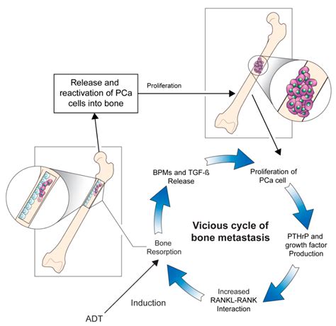 Cancers Free Full Text Pathophysiology Of Bone Loss In Patients