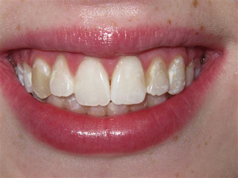 Calcium Deposits Teeth Whitening Teeth Bonding