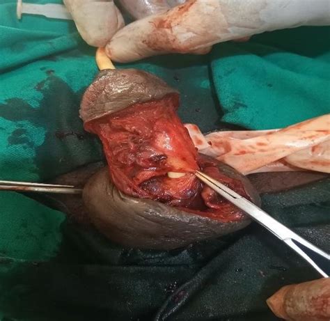 Penile Fracture With Bilateral Rupture Of The Corpora Cavernosa