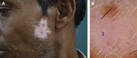 Dermoscopy Of Pigmentary Disorders In Brown Skin Dermatologic Clinics