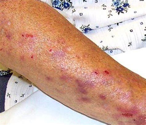 Calciphylaxis Pictures Symptoms Diagnosis Treatment Causes Hubpages