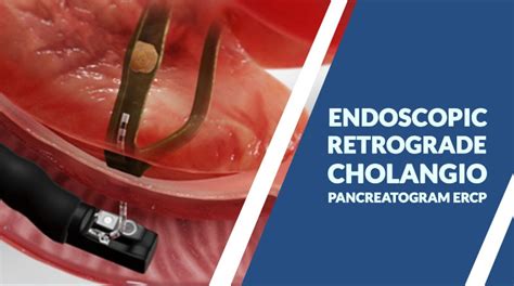 Endoscopic Retrograde Cholangio Pancreatogram Ercp