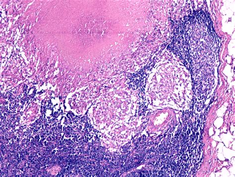 Caseous Necrosis And Granulomatous Lesions In Lymph Node He Staining