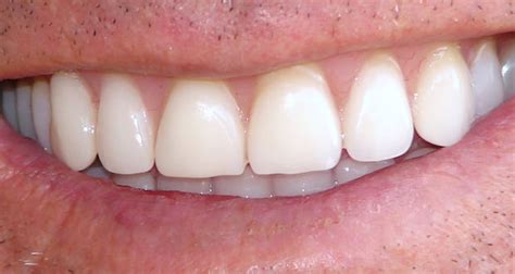 Use the proper solution and cleaning techniques that your dental team has provided. A Guide to Denture Adhesive