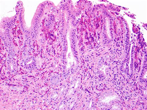 Pathology Outlines Eosinophilic Gastroenterocolitis
