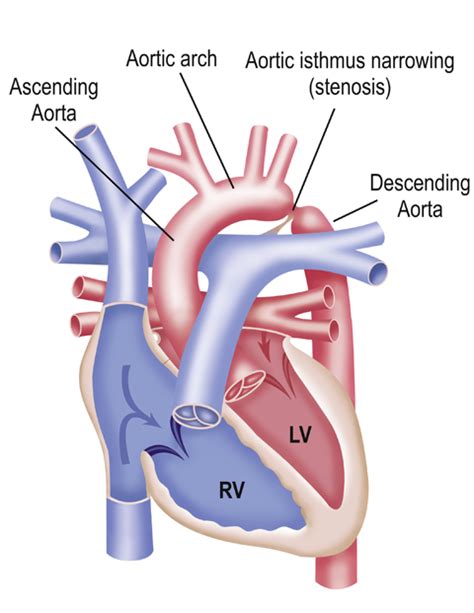 Dhzb Aortic Isthmus Stenosis Ista Coarctation Of The Aortic Isthmus