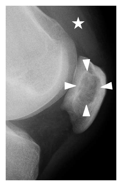 Figure 2 Tophaceous Gout Of The Patella A Report Of Two Cases