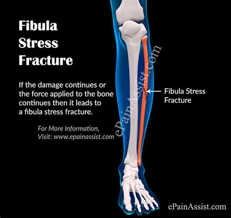 What Is Tibia And Fibula Fracture Fibula Fracture Symptoms Treatment