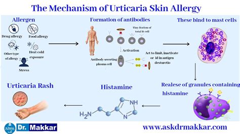 Urticaria Hives Homeopathic Treatment Skin Allergic Reaction Creating
