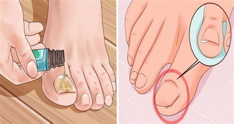 Cuts and scrapes are caused by various types of injuries but most of them are harmless and go away after a few days. How to Get Rid of a Painful Ingrown Toenail as Fast as ...