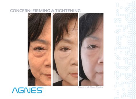 AGNES RF Fat Removal That Tightens Smooths And Sculpts