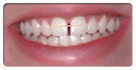How to reduce gap between teeth naturally at home? Teeth Gap Bands - Close Gapped Teeth