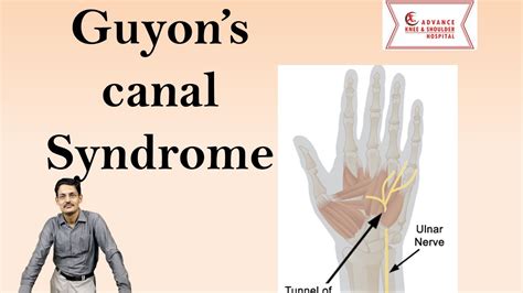 Guyons Canal Syndrome Youtube