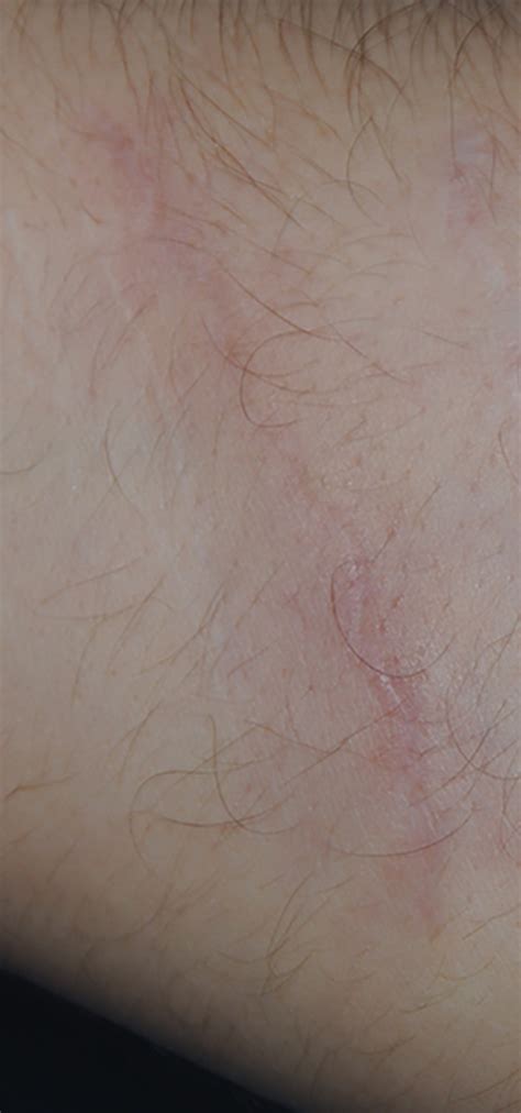 Scar Revision Before And After Images Seattle Bellevue