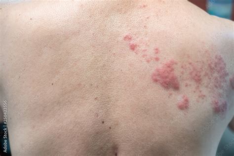 Shingles Disease Herpes Zoster Varicella Zoster Virus Skin Rash