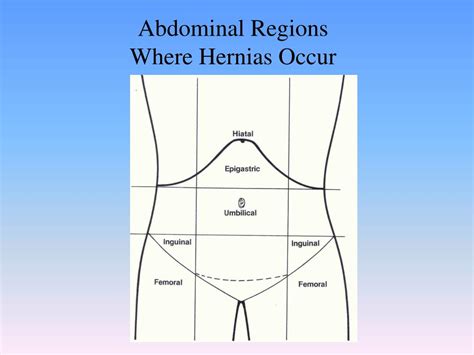 Ppt Traditional Hernia Repair Powerpoint Presentation Free Download