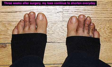 My Toe Shortening Surgery And Hammertoe Hammer Toe Surgery Blog