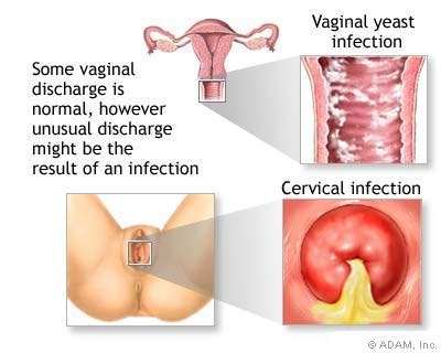 White discharge before your period is one such form of discharge that may occur for many reasons. Vaginal discharge - normal and abnormal - Women Health ...