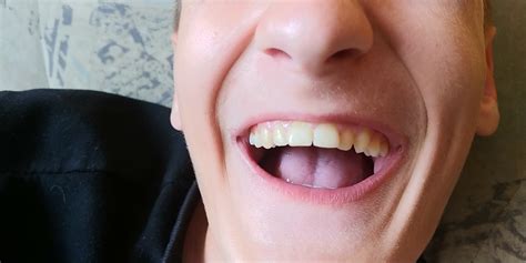 15 Years Old Teeth Outward Tilt Splayed Teeth Case Discussions