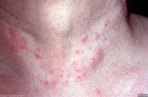 Dermatitis Herpetiformis Ziekte Van Dühring