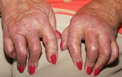 Psoriatic Arthritis The Signs Symptoms And Types