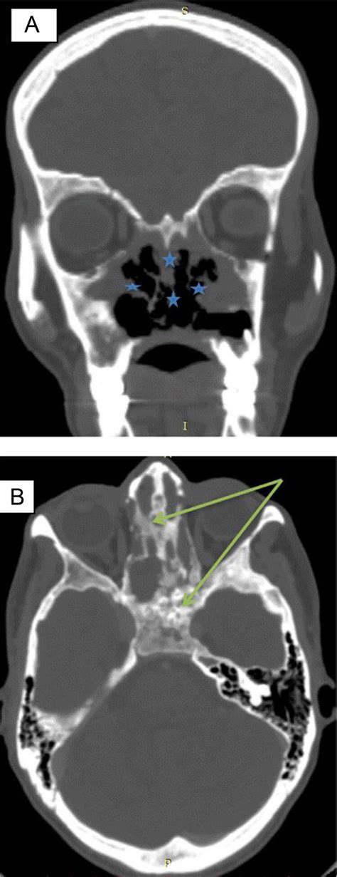 A And B Ct Scan Of Pns Coronal And Axial Section In Bone Window