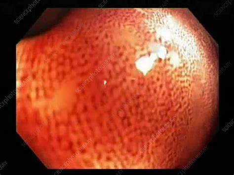 Melanosis Coli In The Colon Endoscopy Footage Stock Video Clip