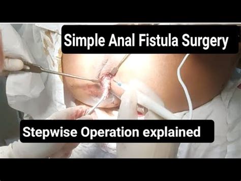 Simple Anal Fistula Surgery Procedure Surgeon Dr Imtiaz Hussain Youtube