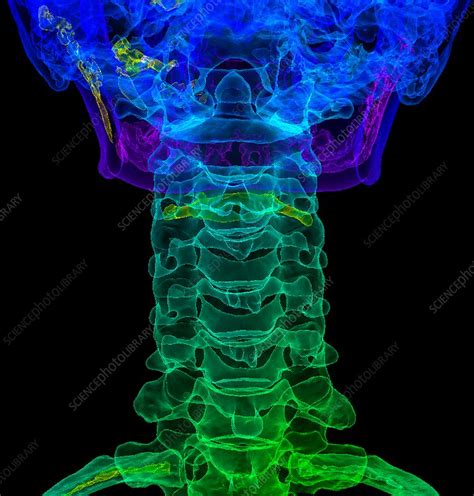 Cervical Spine Anatomy 3d Ct Scan Stock Image C0345265 Science