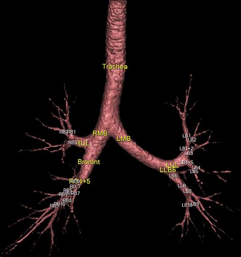 Three Dimensional Chest Ct Scan Of The Bronchial Tree The Figure