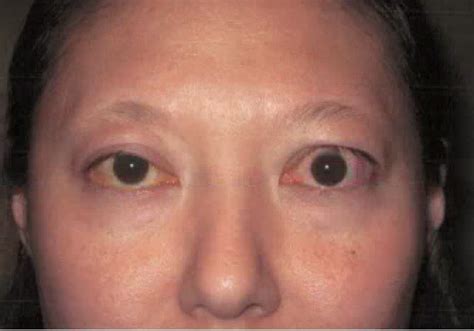 Treat Thyroid Eye Diease in Austin | Graves' Disease | Dr. Amato