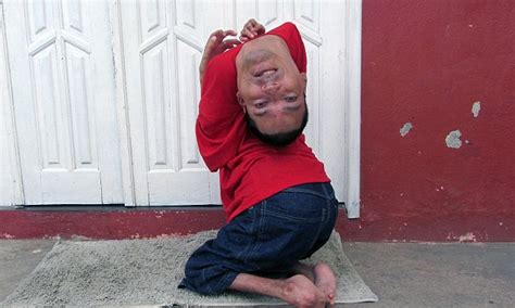 How The Baby Born With The Upside Down Head Has Defied Doctors Who Told