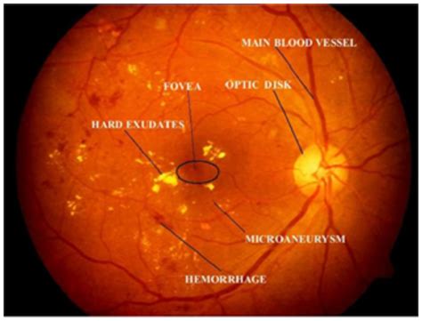 Detection Of Diabetic Retinopathy Using A Fusion Of Textural And