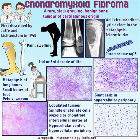 Chondromyxoid Fibroma Is A Rare Benign Bone Tumour Of Cartilaginous