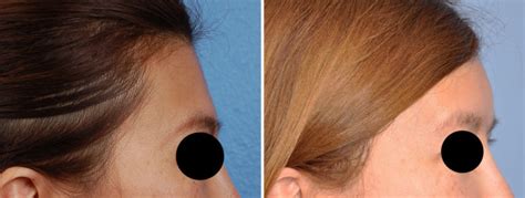 Plastic Surgery Case Study Hydroxyapatite Cement Forehead