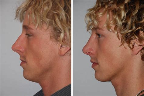 Rhinoplasty Nose Surgery Nose Job For Men In New York City David