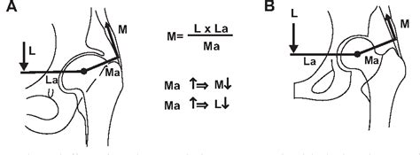 Figure 3 From Treatment Of Coxa Brevis Semantic Scholar
