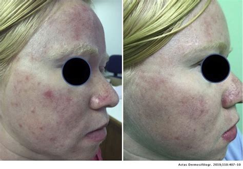 Daylight Photodynamic Therapy In The Treatment Of Actinic Keratosis In