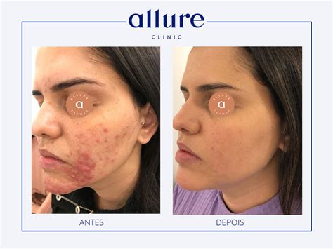 Rosacea Em Pele Morena
