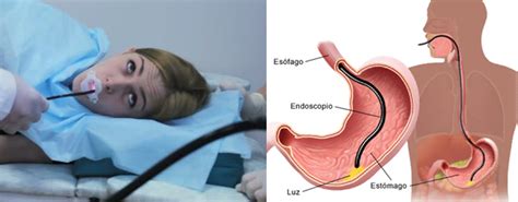 Una endoscopia es un procedimiento médico que permite realizar un análisis del interior del cuerpo introduciendo una sonda con cámara. Clínica Endoscopias Monterrey