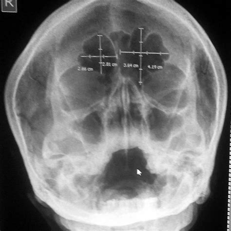 Paranasal Sinus Radiograph Showing Measurements Of Frontal Sinus Figure