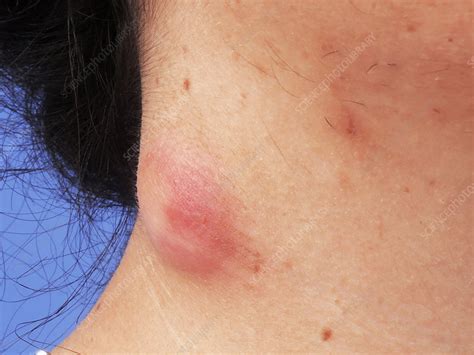 Sebaceous Cyst Stock Image C0254613 Science Photo Library