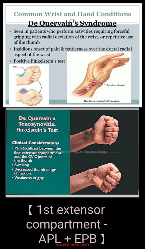 De Quervain S Tenosynovitis Occupational Therapy Treatment Murray Mezquita