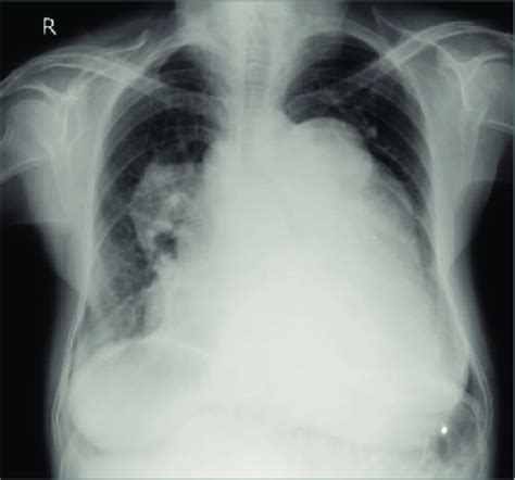 Showing Massive Cardiomegaly On Chest X Ray Pa View Figure 2 Showing