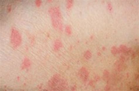 Inflammatory Skin Disease