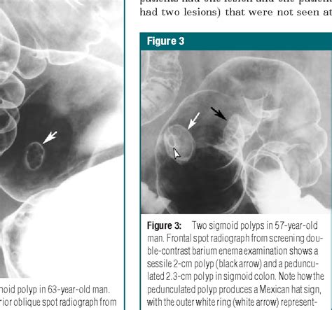 Figure 3 From Colorectal Cancer Screening Double Contrast Barium